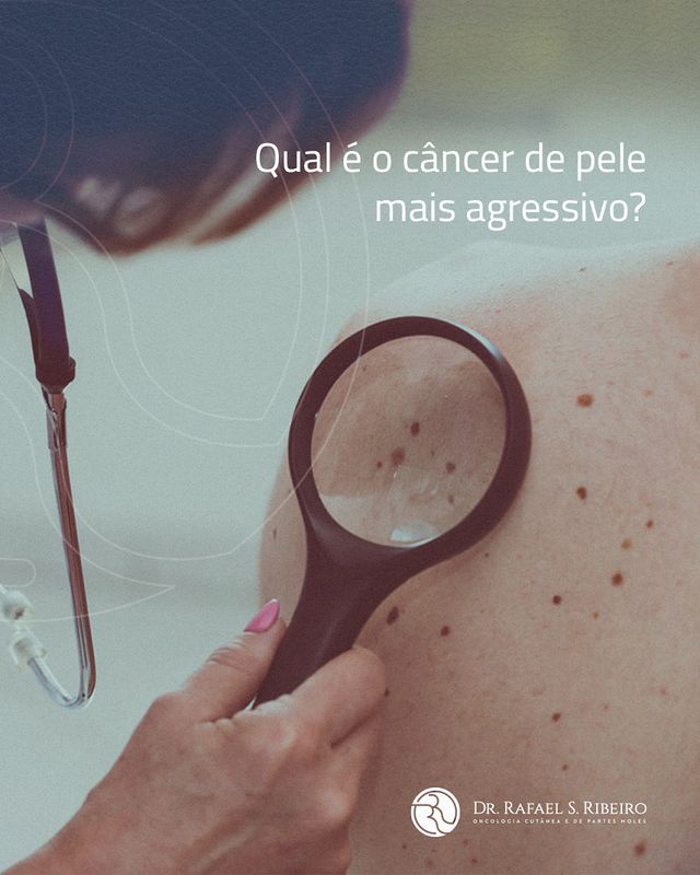 Qual é o câncer de pele mais agressivo?