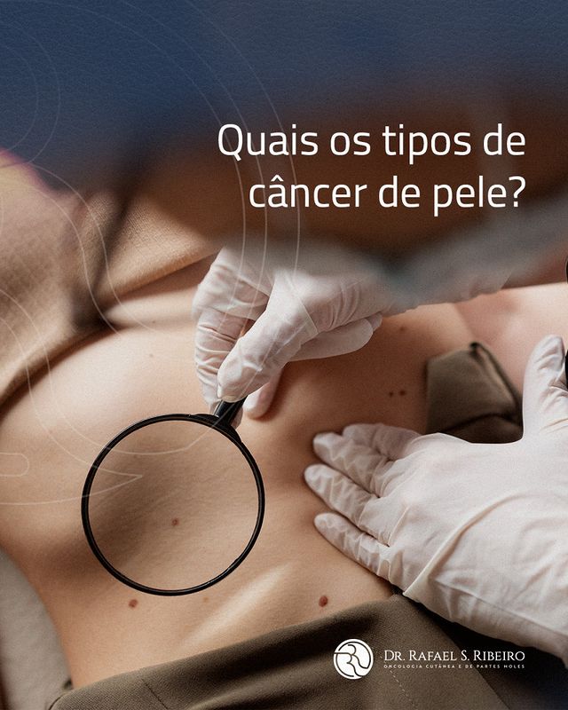 Quais os tipos de câncer de pele?