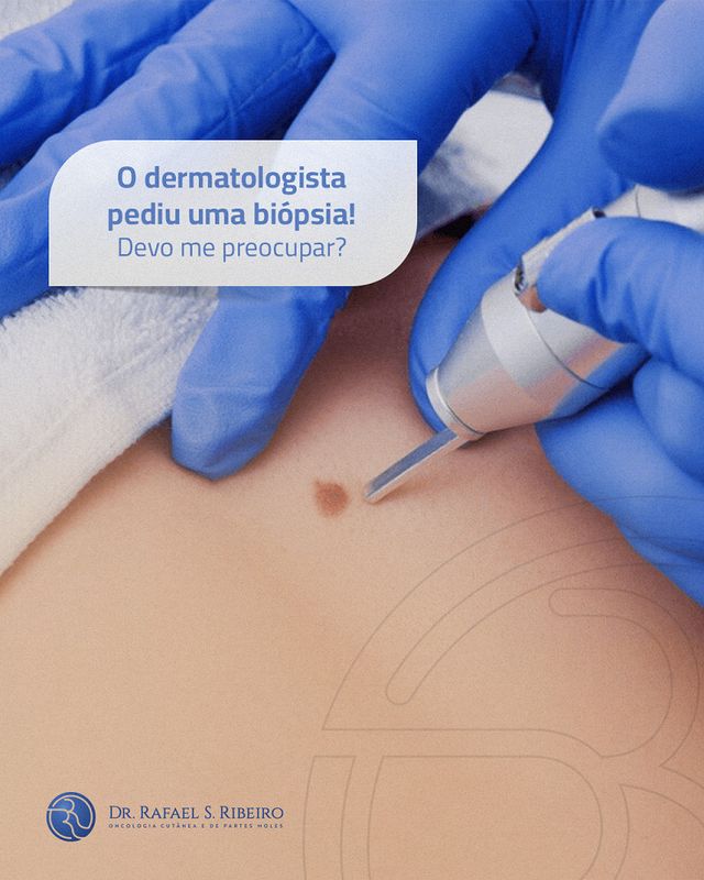 O dermatologista pediu uma biópsia! Devo me preocupar?