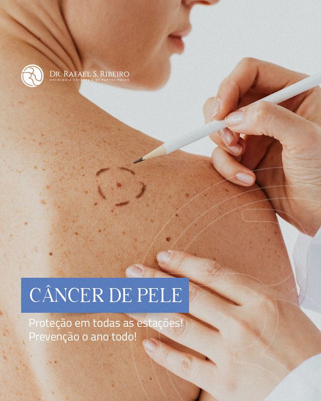 Câncer de pele - Proteção em todas as estações! Prevenção o ano todo!