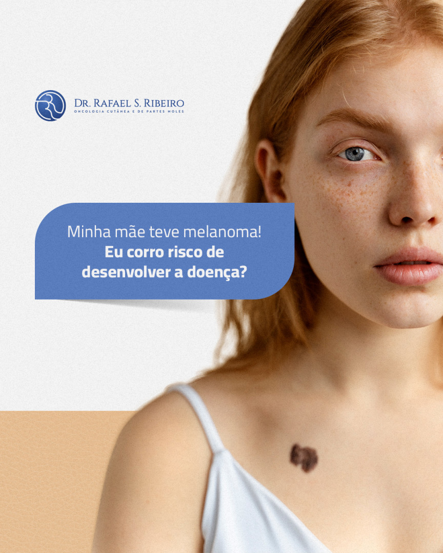 Minha mãe teve melanoma! Eu corro risco de desenvolver a doença?