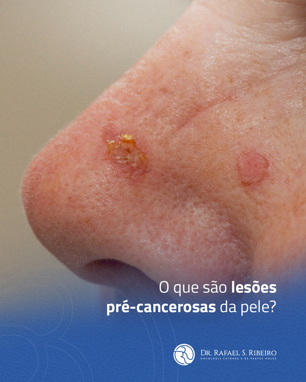 O que são lesões pré-cancerosas da pele?