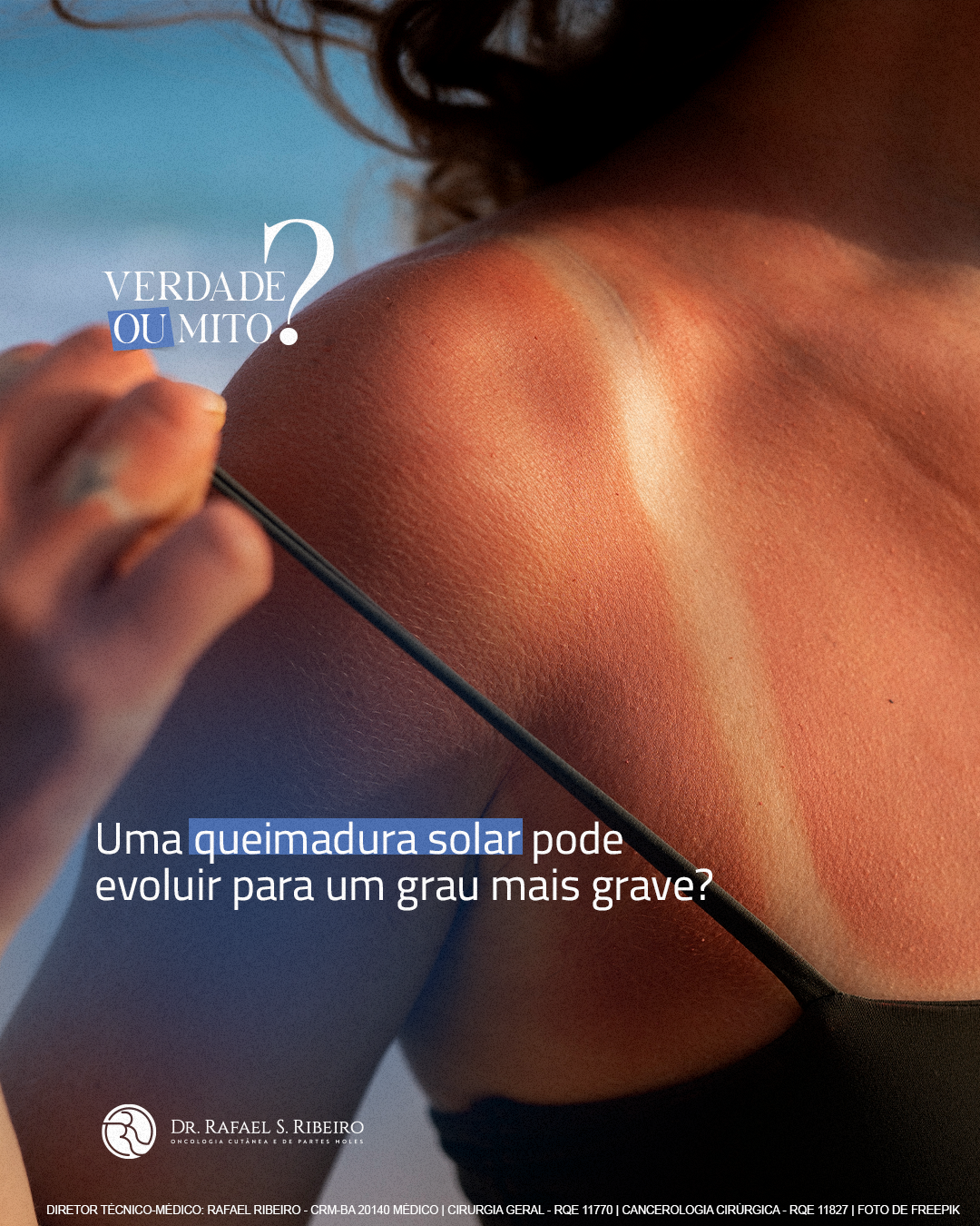 Uma queimadura solar pode evoluir para um grau mais grave?