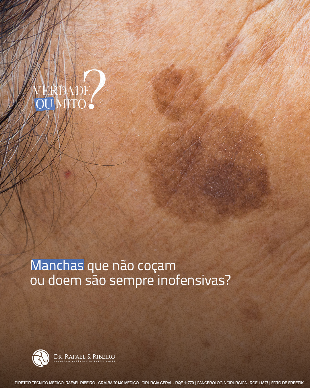Manchas que não doem são sempre inofensivas? Cuidado com esse mito!